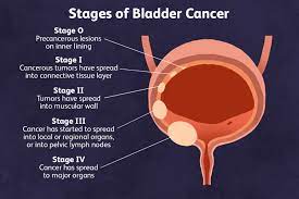 Understanding and Preventing Bladder Cancer